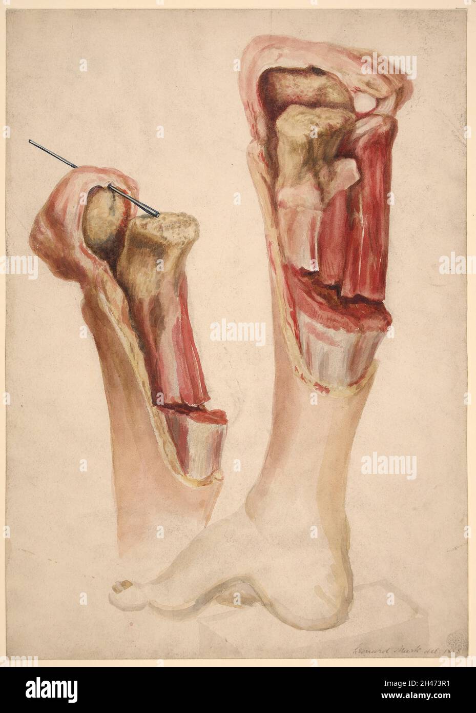Foot and leg of a boy who had acute inflammation of the upper epiphysis of the tibia Stock Photo