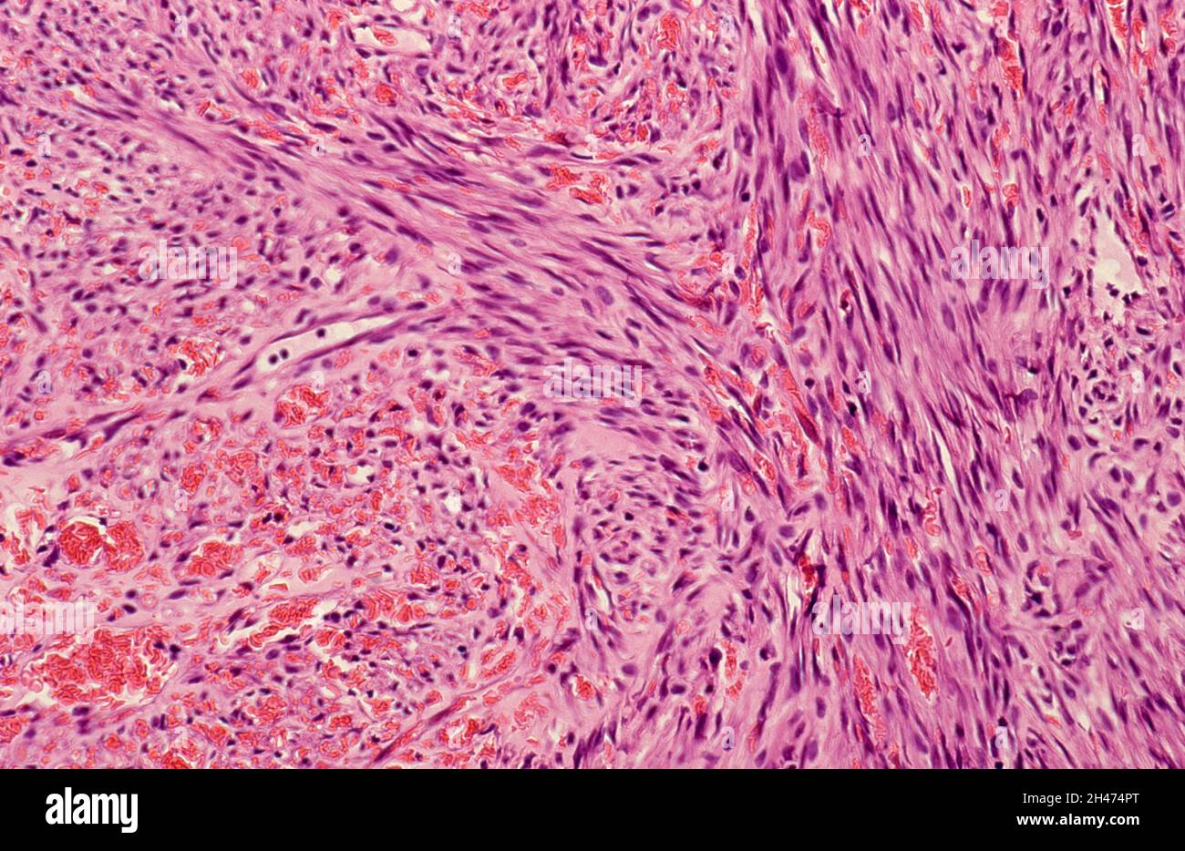 Lymph node: Kaposi's sarcoma Stock Photo