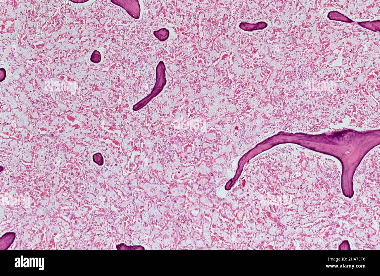 Bone marrow gelatinous transformation with AIDS Stock Photo Alamy