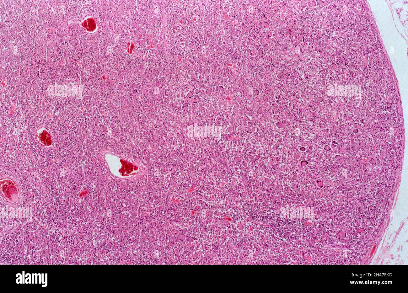 Mycobacterium avium-intracellulare infection and HIV Stock Photo - Alamy