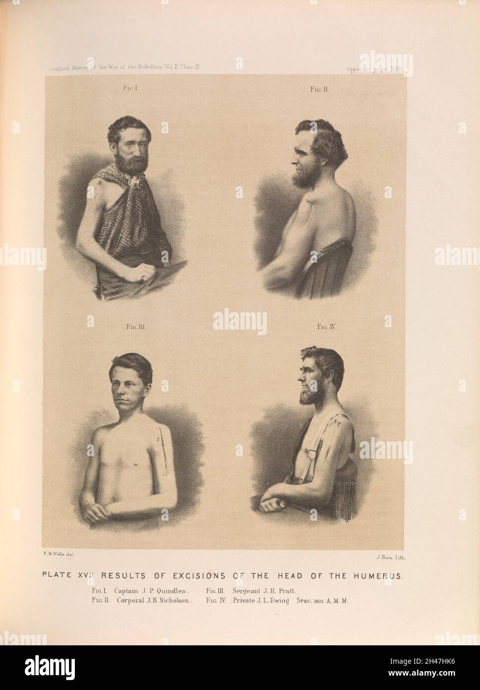 Plate XVII. Results of excisions of the head of the humerus. American Civil War (1861-65). Stock Photo