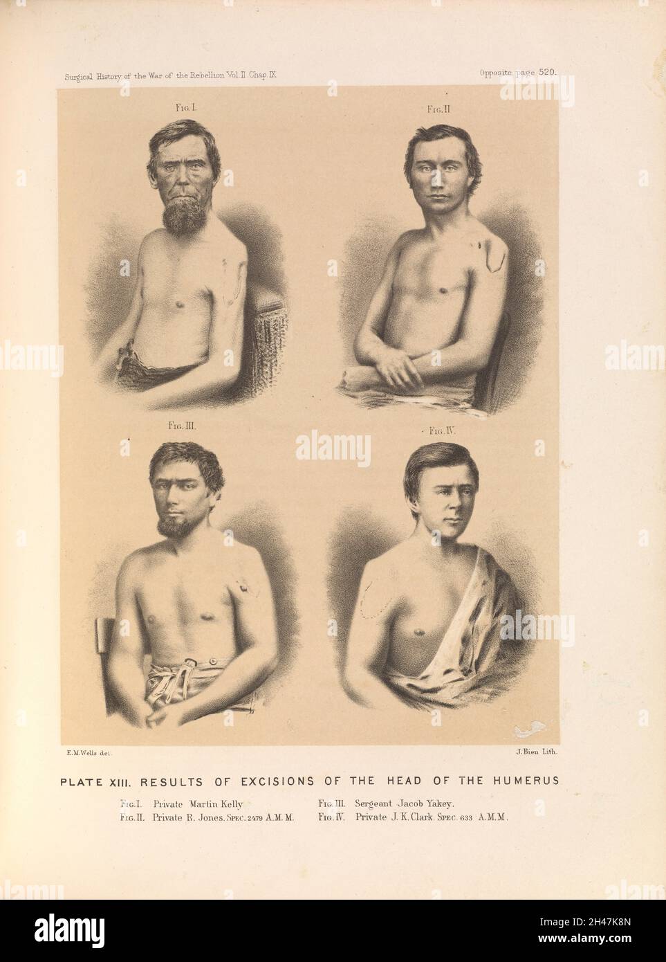 Plate XIII. Results of excisions of the head of the humerus. American Civil War (1861-65). Stock Photo