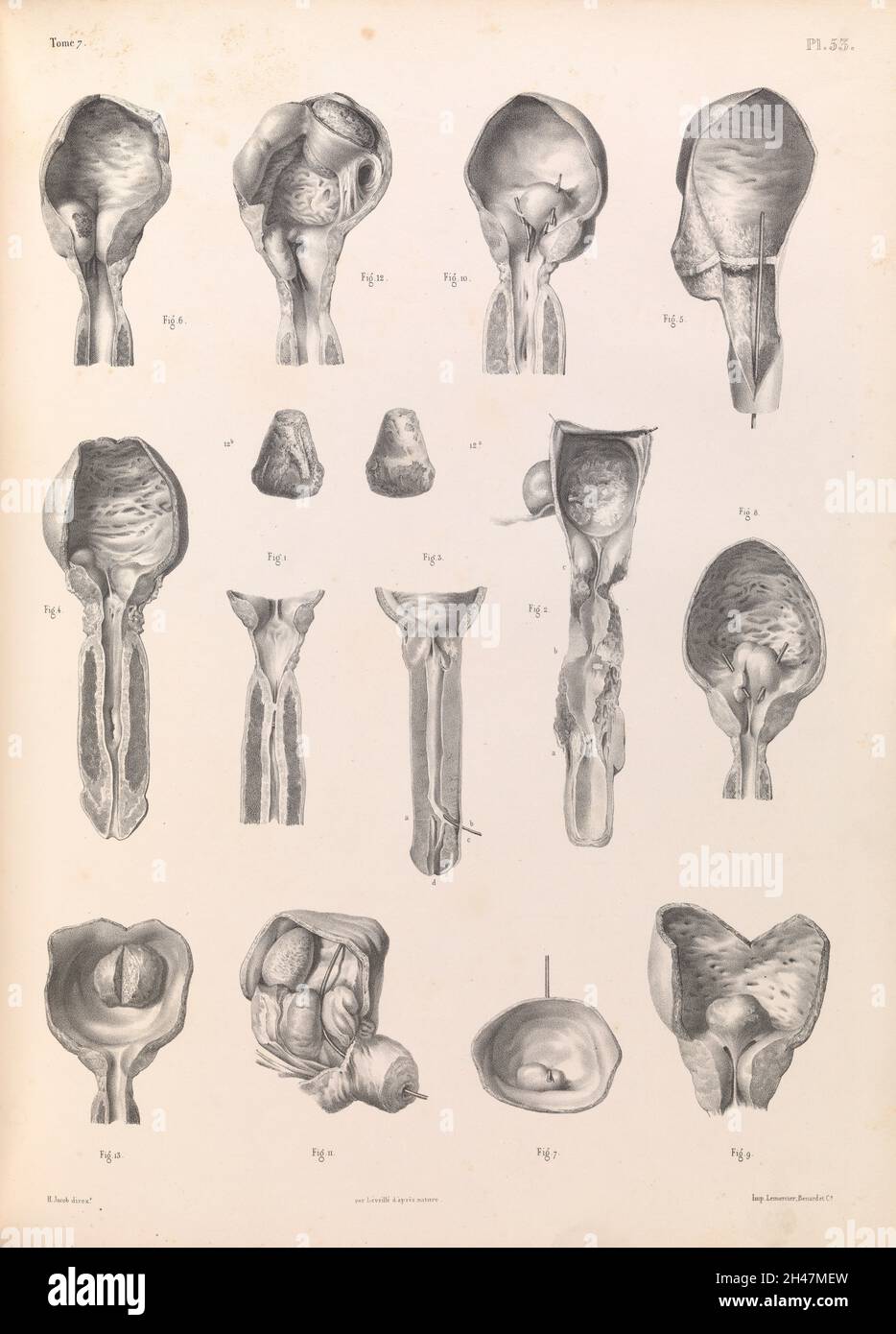 Plate 53. Pathology of the male genitalia, urinary organs. Stock Photo