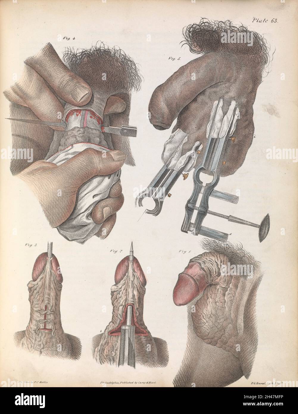 Plate LXIII. Surgical techniques performed on male genitalia. Stock Photo
