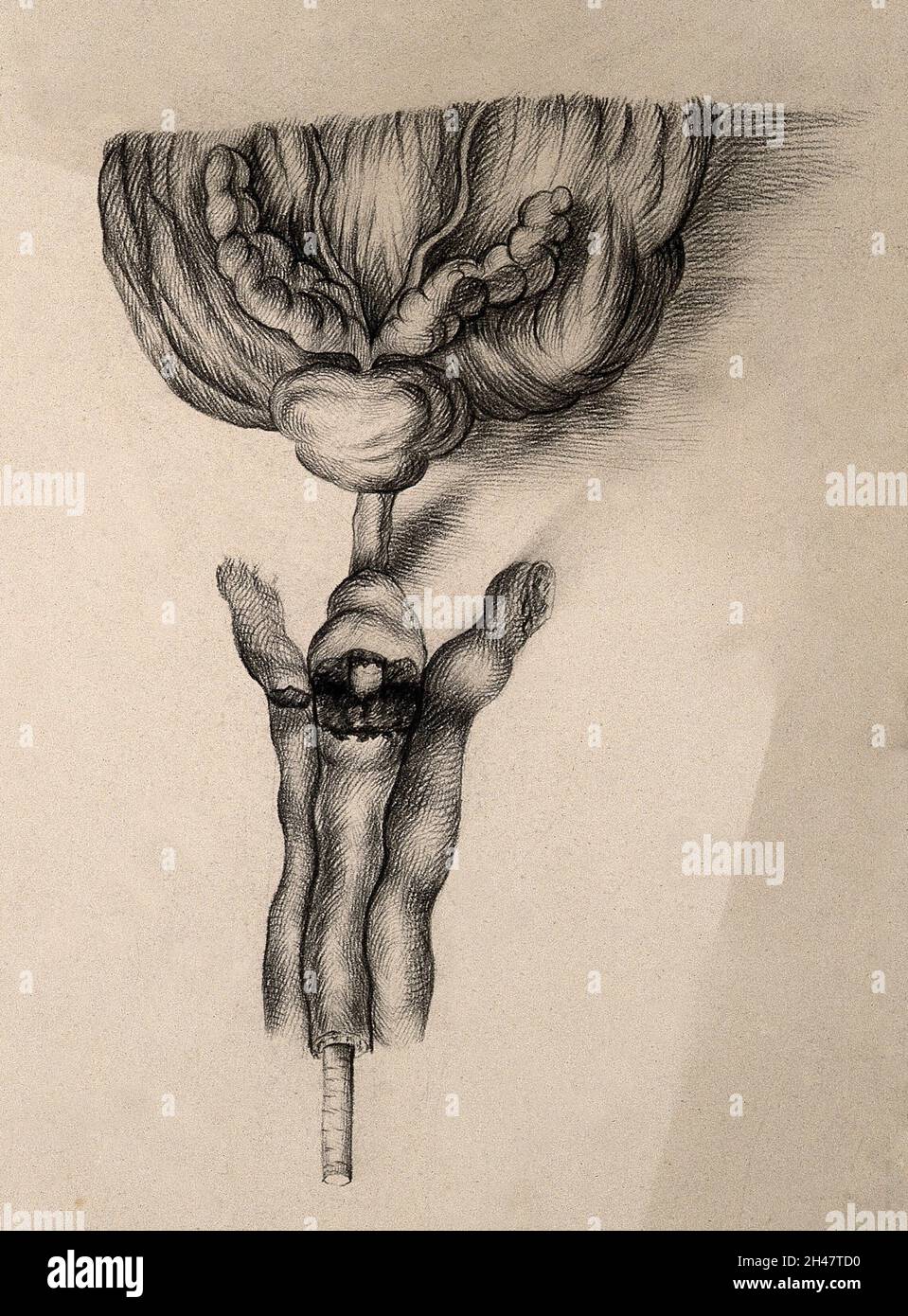 A diseased part of the body. Drawing Stock Photo - Alamy