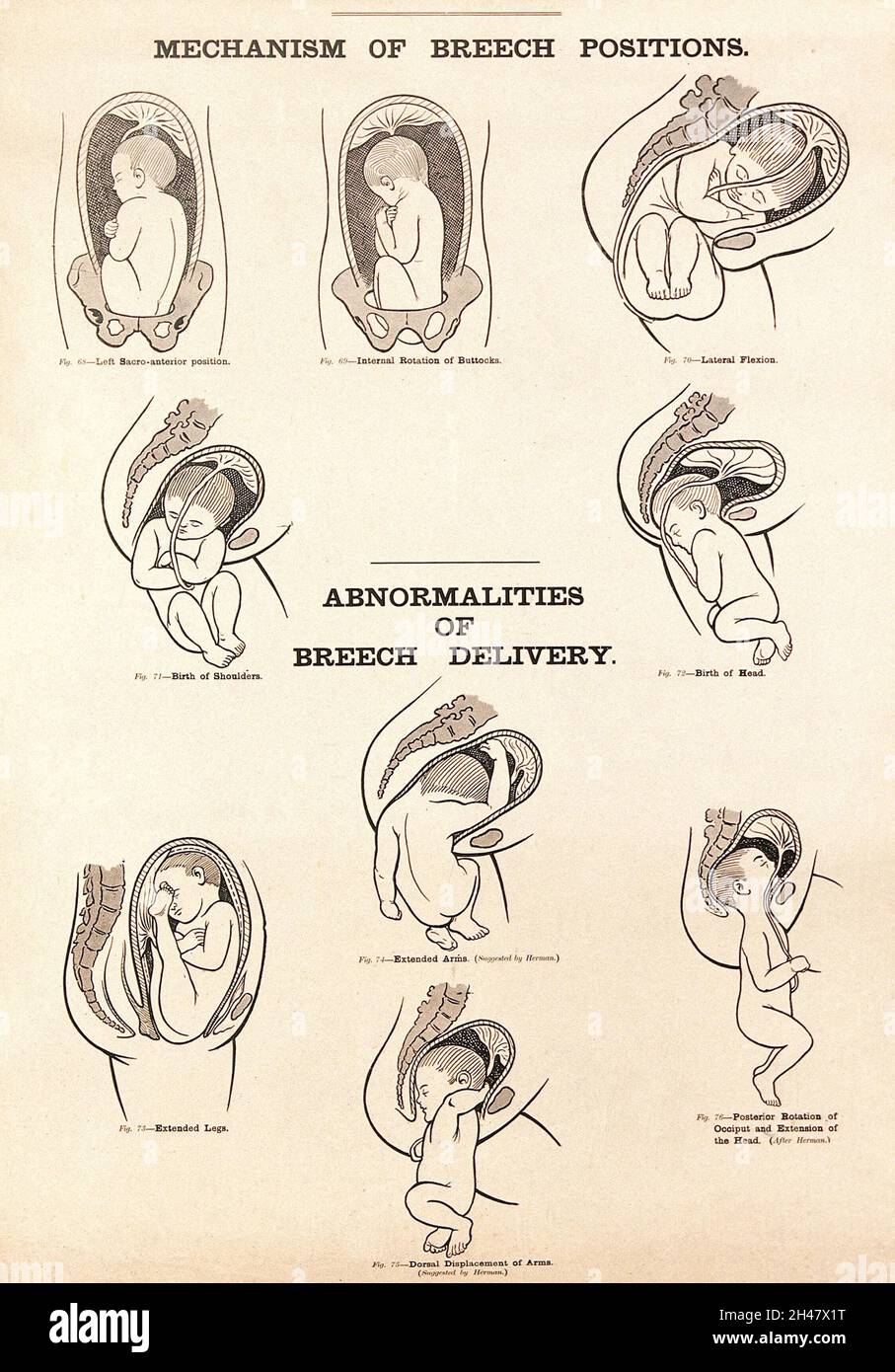 Mechanism of breech positions and abnormalities of breech delivery. Lithograph after W. F. Victor Bonney. Stock Photo