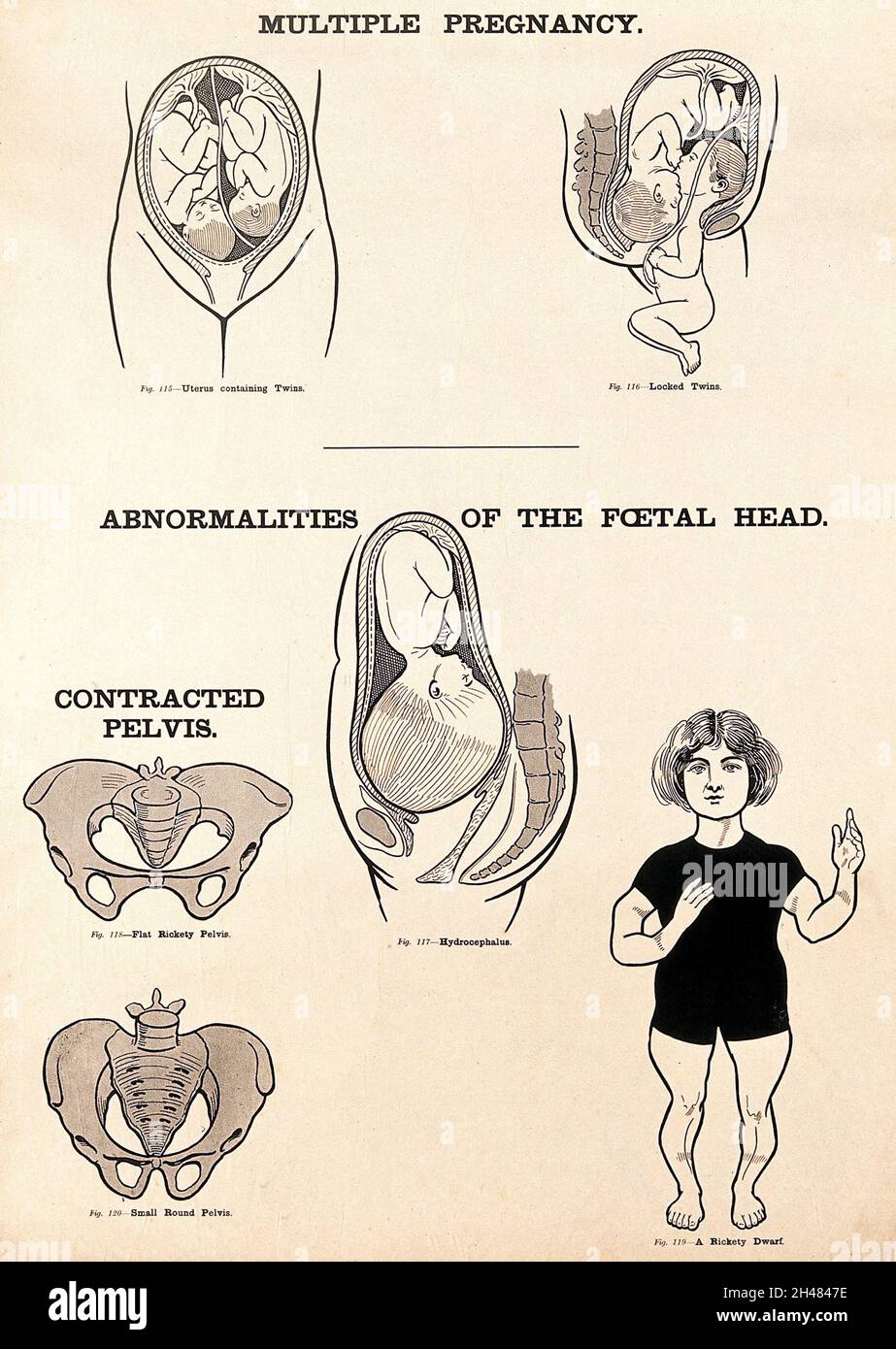 A textbook of obstetrics . Fig. 253. Presentation I the umbili  ABNORMALITIES IN MECHANISM. 93 cent parts—namely, the axilla, the clavicle,  the spine of thescapula, the acromion process, the head of the