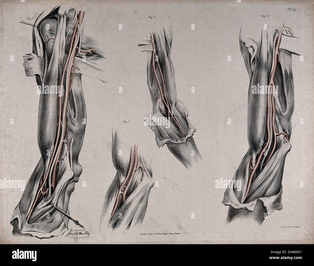Surgery shoulder incision hi-res stock photography and images - Alamy