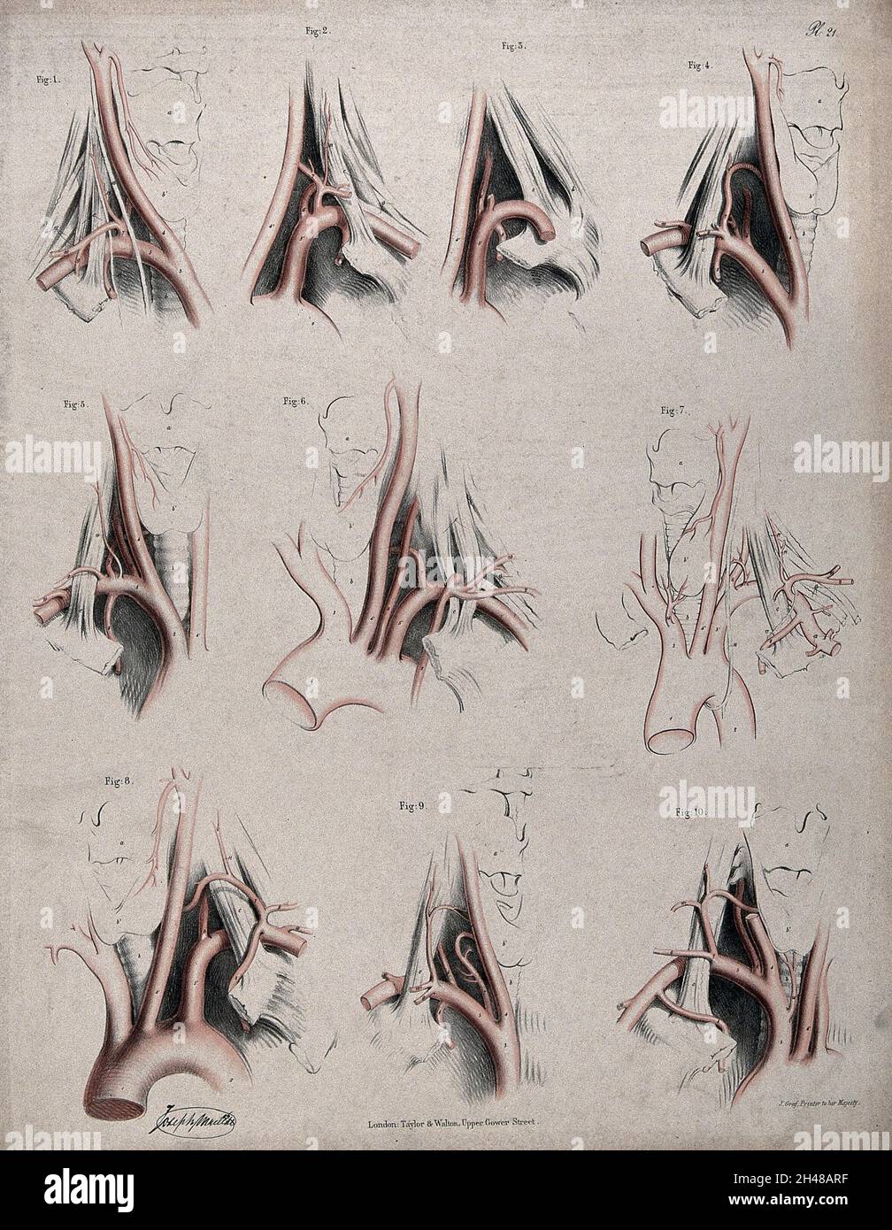 Complete Arch Dissection The circulatory system: dissections showing the aortic arch ...