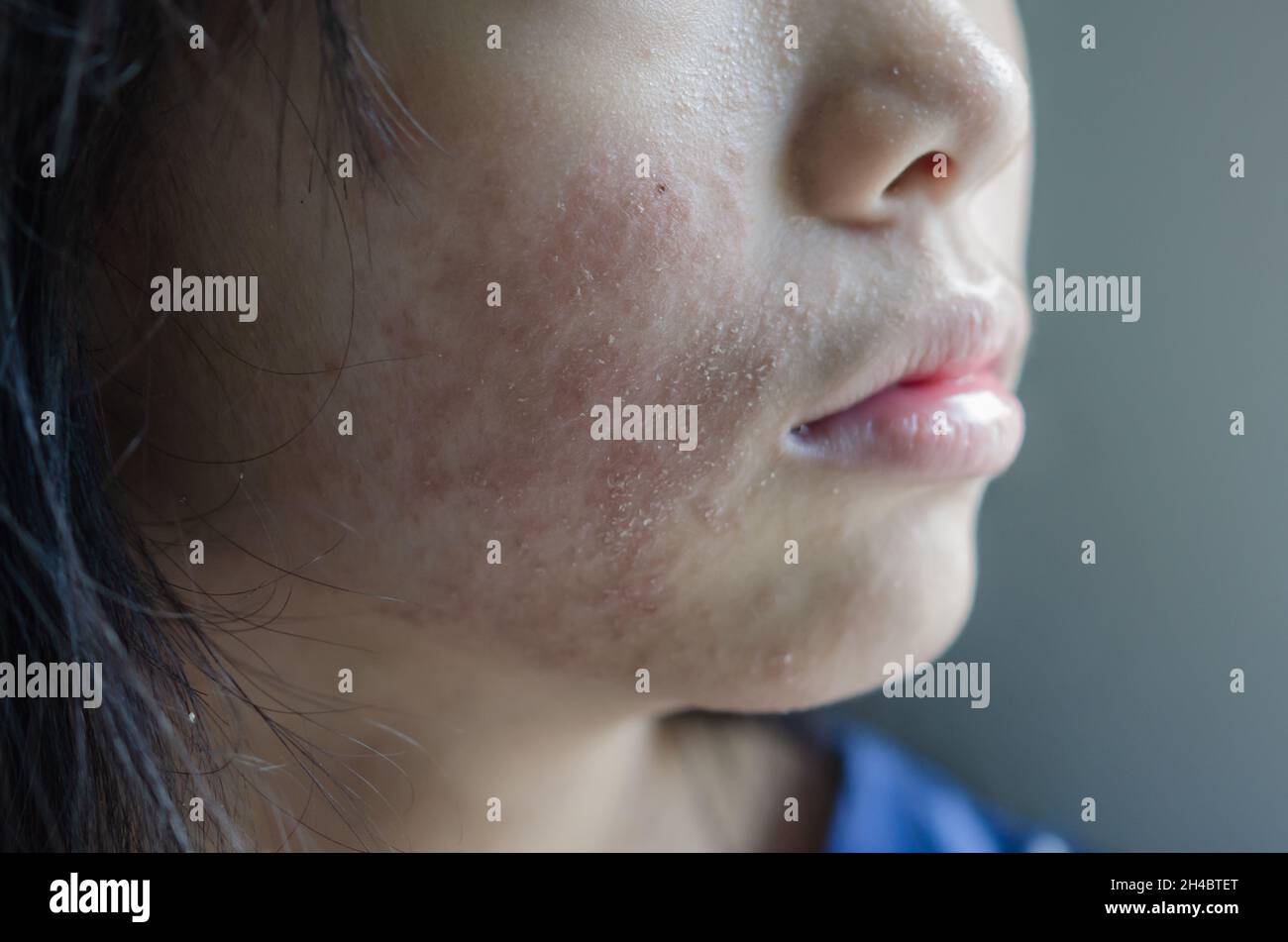 rash face woman allergic to cosmetics food allergy or air allergy Stock