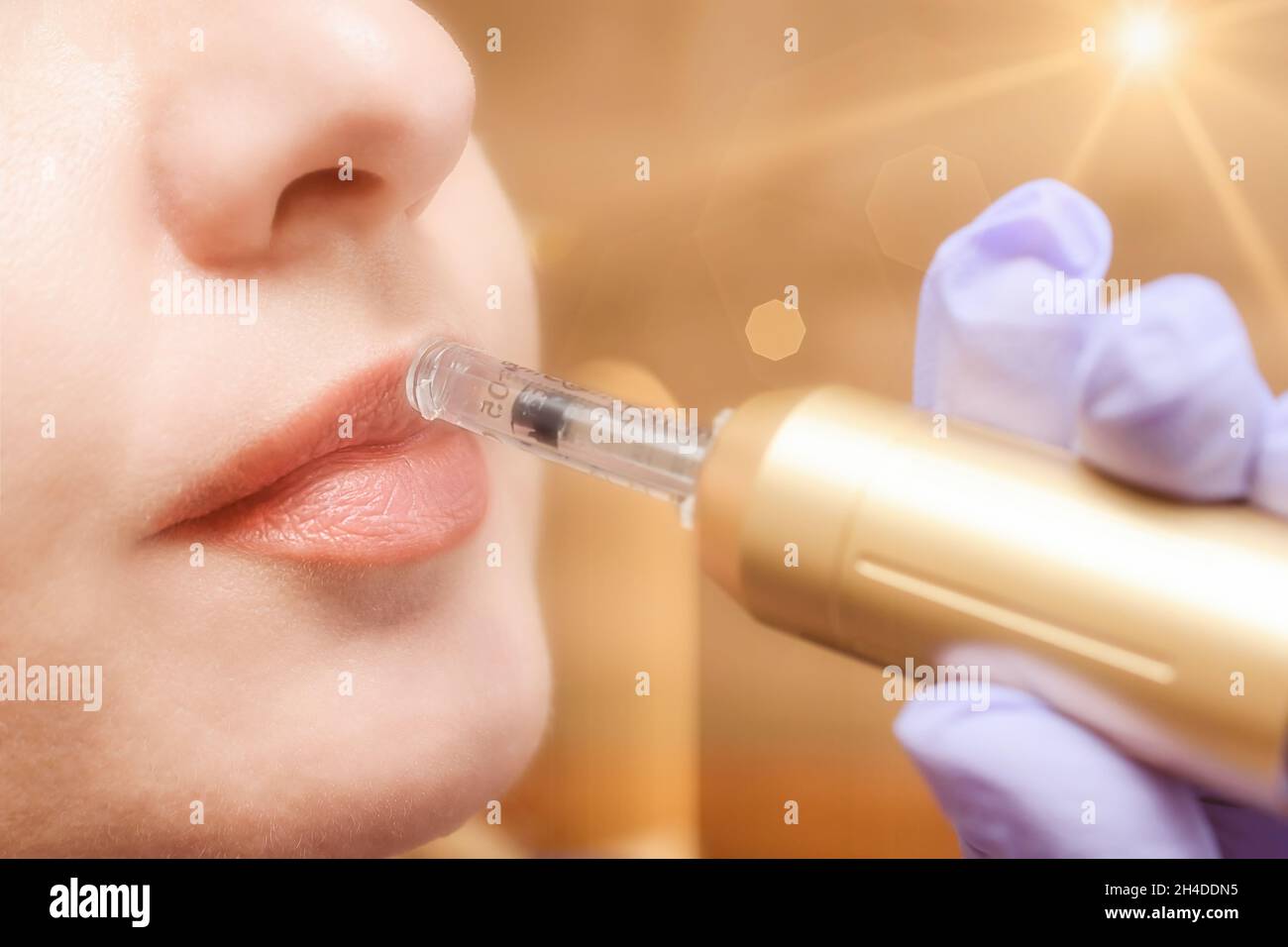 Lip augmentation treatment using needlefree mesotherapy with hyaluron