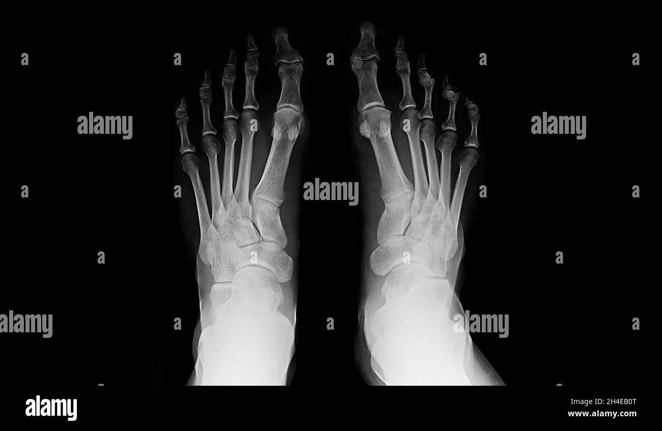 human right and left foot ankle xray picture (top view Stock Photo Alamy