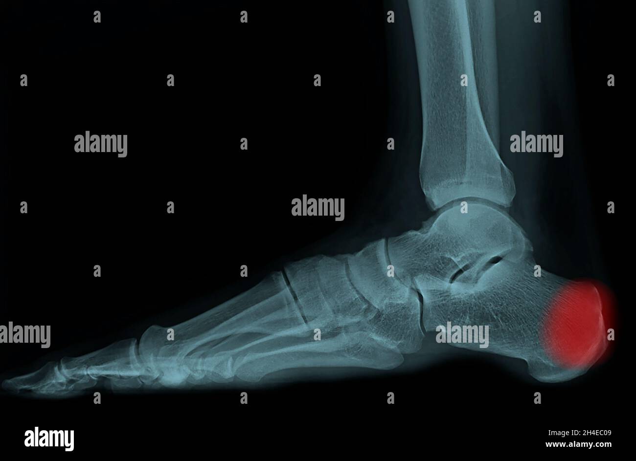 Lateral X Ray Of Foot And Ankle The Film Show Normal Bone And Joint The Patient Has Achilles