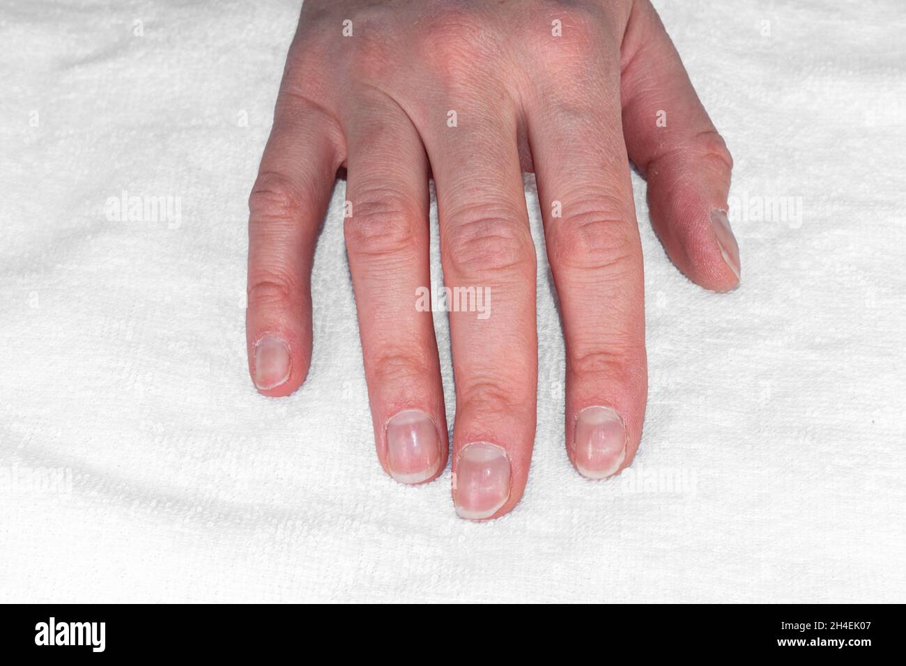 Black line on finger nail - Melanoma? Skin cancer? - Page: 3
