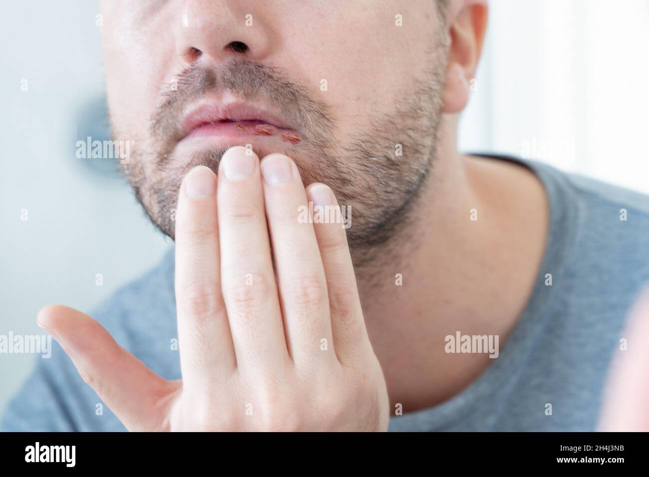 Man suffering for herpes simplex on the lips Stock Photo
