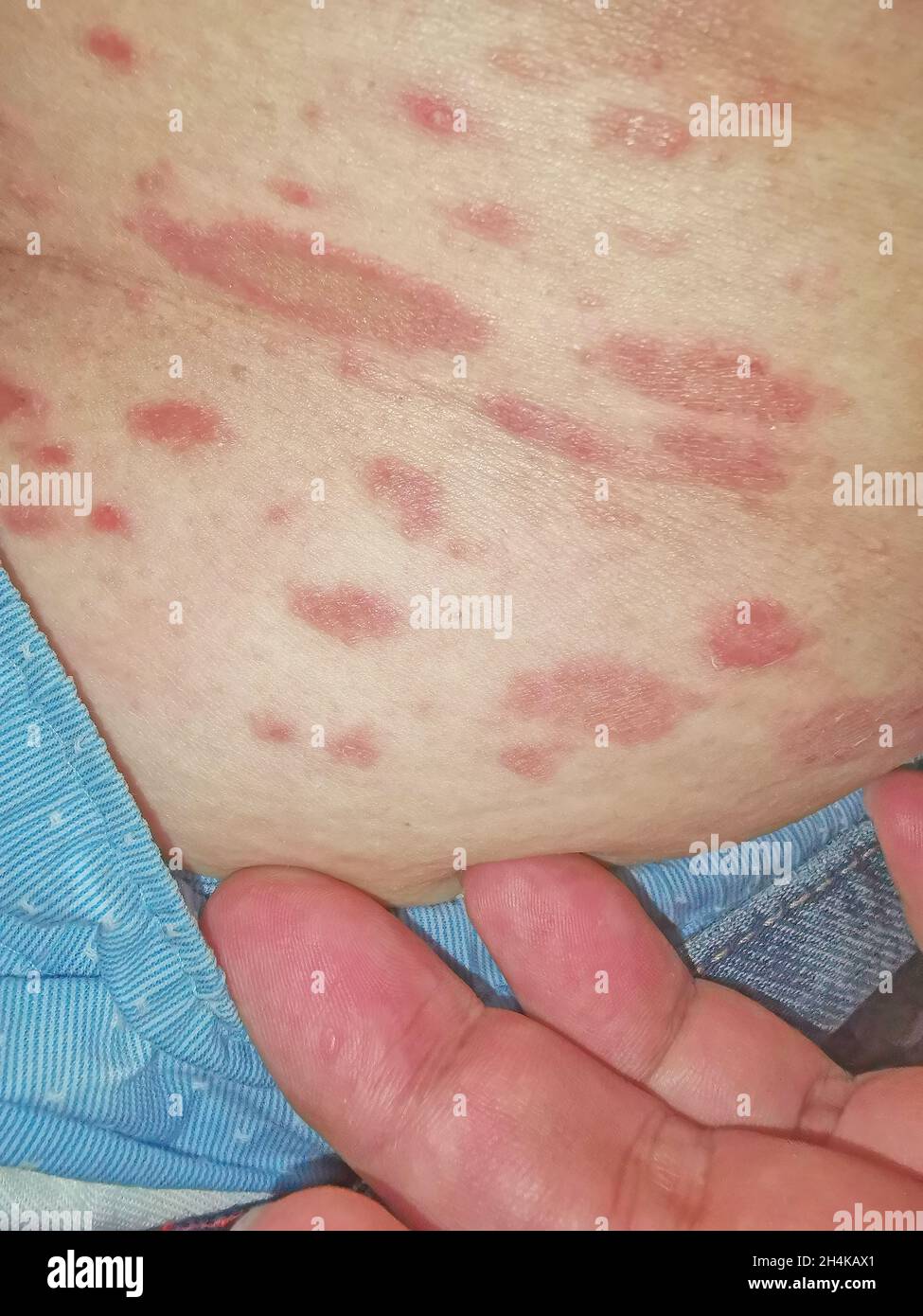 PR Pityriasis rosea is a skin disease. It is assumed that it may be caused by a virus. which cannot be clearly proven Stock Photo