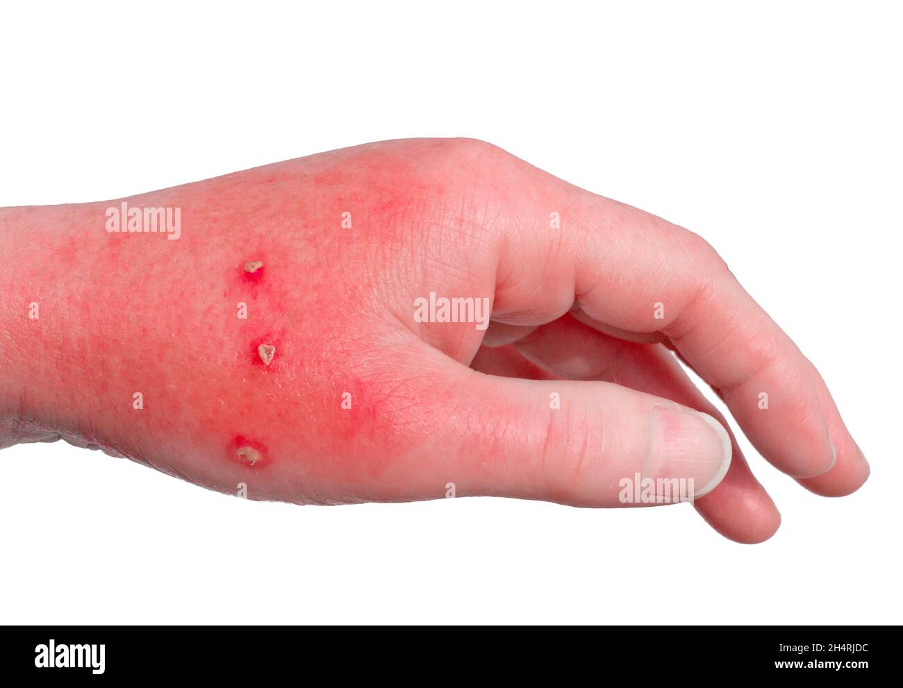 Infected Cat Bite Isolated On White Stock Photo Alamy