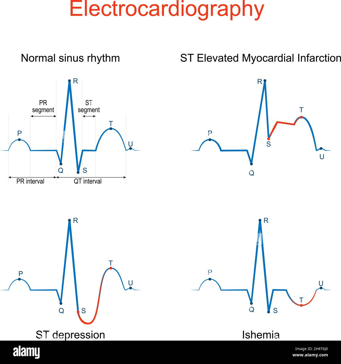 Electrocardiography. ECG or EKG of a heart with normal sinus rhythm, ST Elevated Myocardial Infarction, Ishemia, ST depression. difference and compari Stock Vector