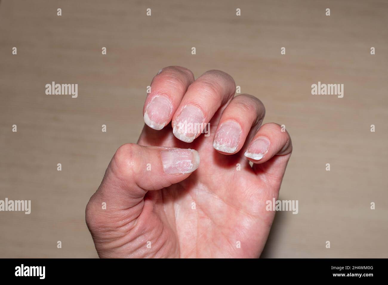Close-up of flaky bitten and brittle nails without a manicure. Regrown nail cuticle and damaged nail plate after gel polish. Health and beauty problem Stock Photo - Alamy Close-up of flaky bitten and brittle nails without a manicure. Regrown nail cuticle and damaged nail plate after gel polish. Health and beauty problem Stock Photo - Alamy