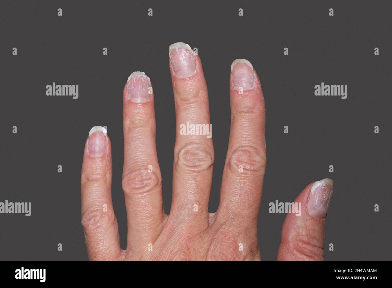 Overgrown cuticle hires stock photography and images Alamy
