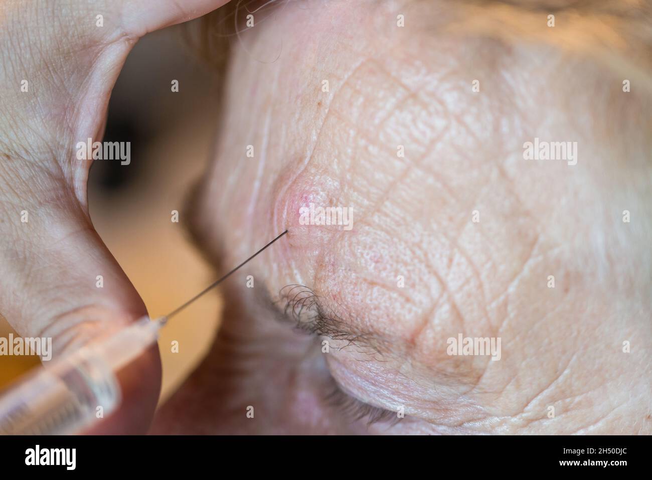 An elderly lady granny gets a medical treatment with needle injection syringe in the forehead with wrinkles , Germany Stock Photo