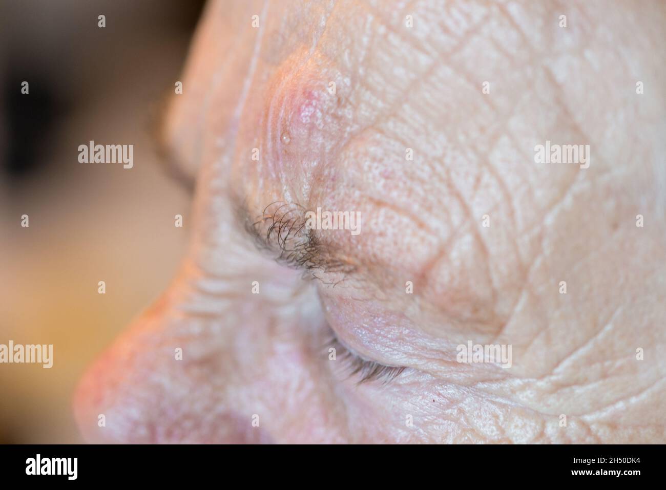 An elderly lady granny gets a medical treatment with needle injection syringe in the forehead with wrinkles , Germany Stock Photo
