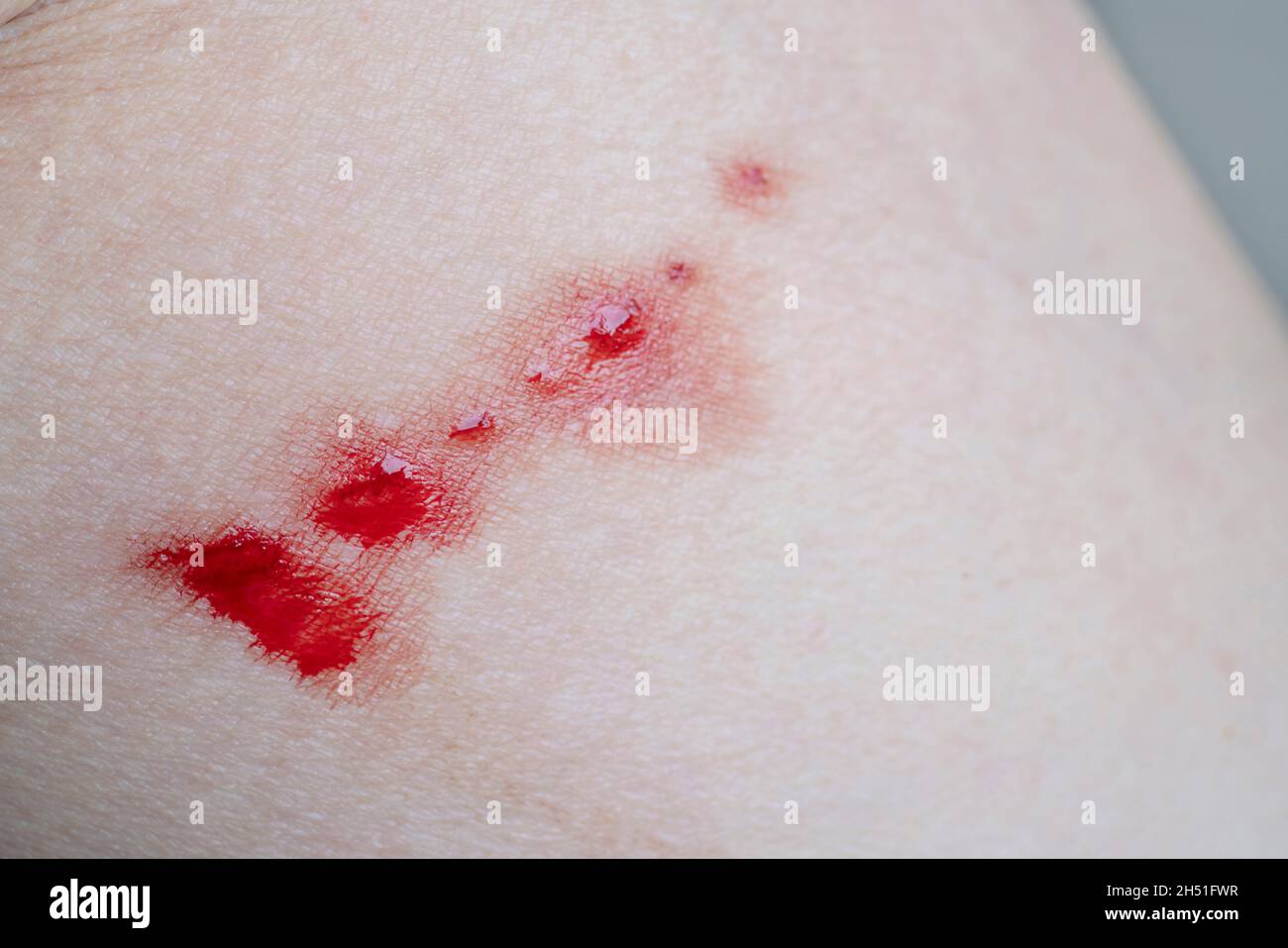 bleeding scar on caucasians skin because of cat scratching Stock Photo
