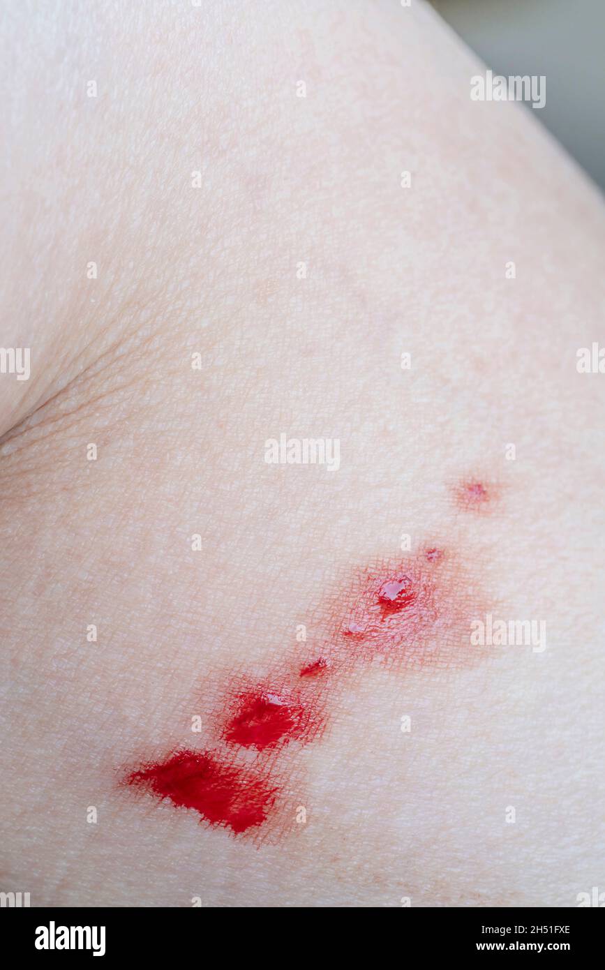 closeup bleeding scar on caucasians skin because of cat scratching Stock Photo