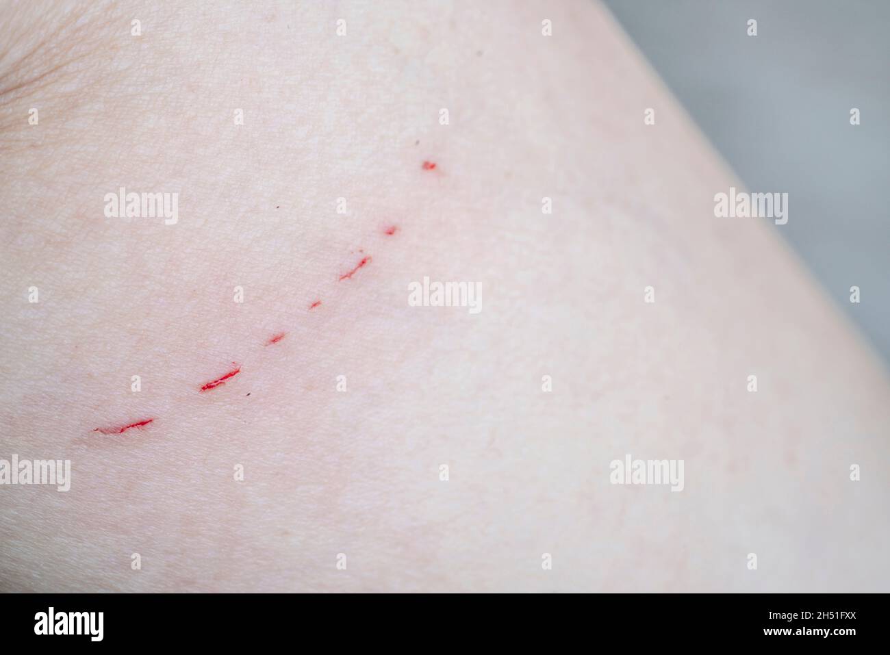 closeup bleeding scar on caucasians skin because of cat scratching