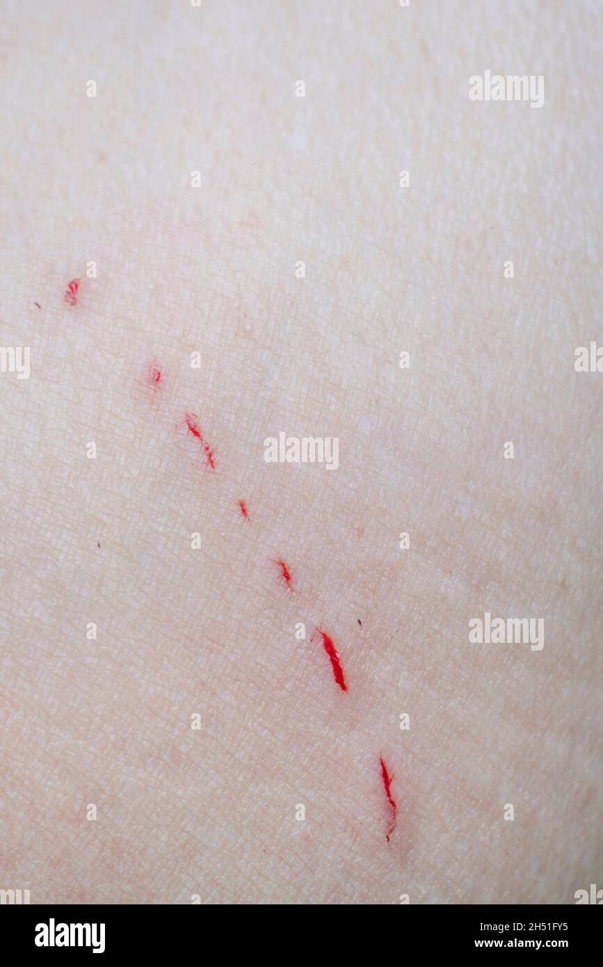 closeup bleeding scar on caucasians skin because of cat scratching