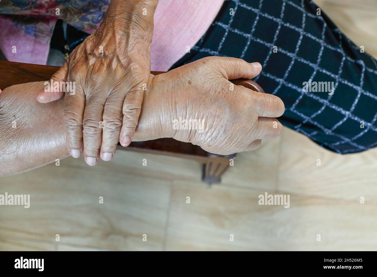 Elderly swollen hand or edema hand Stock Photo Alamy