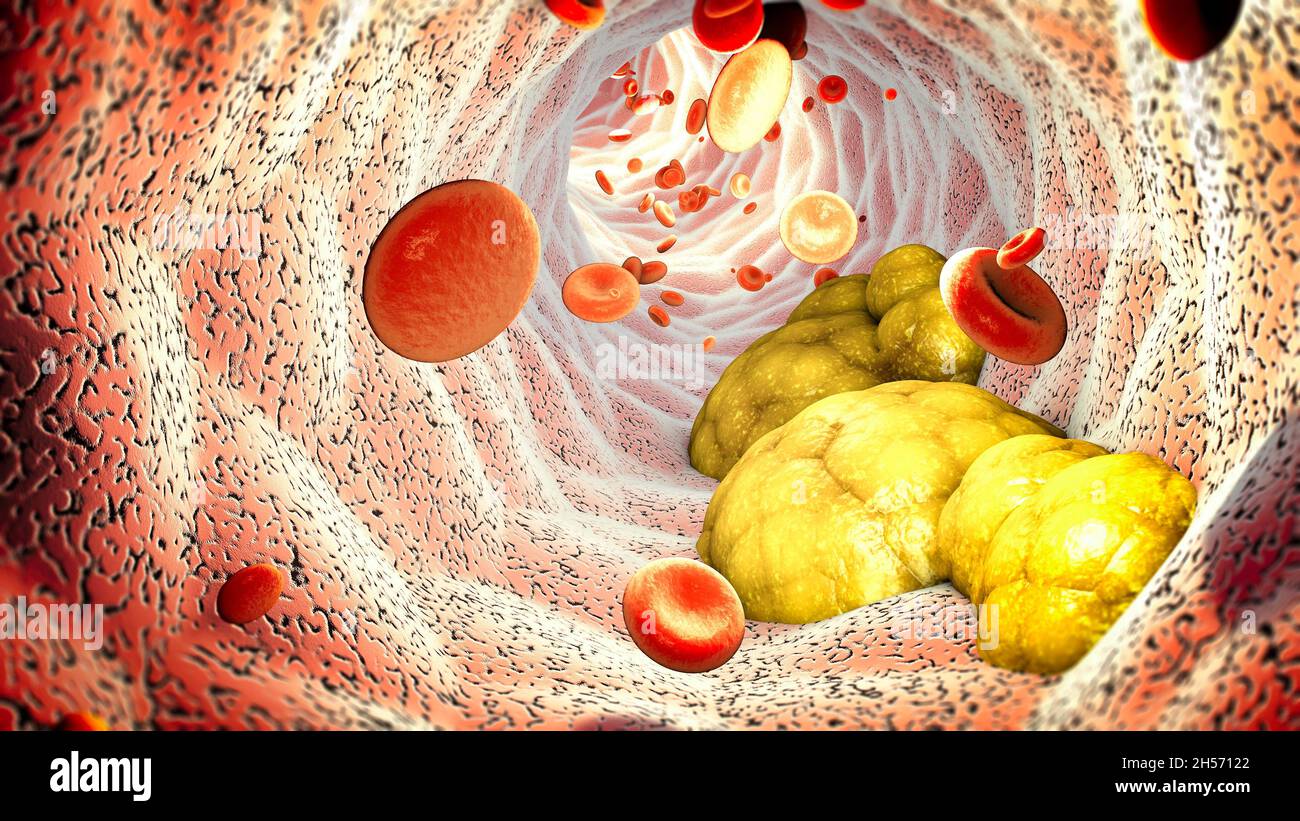 Cholesterol formation, fat, artery, vein, heart. Red blood cells, blood flow. Narrowing of a vein for fat formation Stock Photo