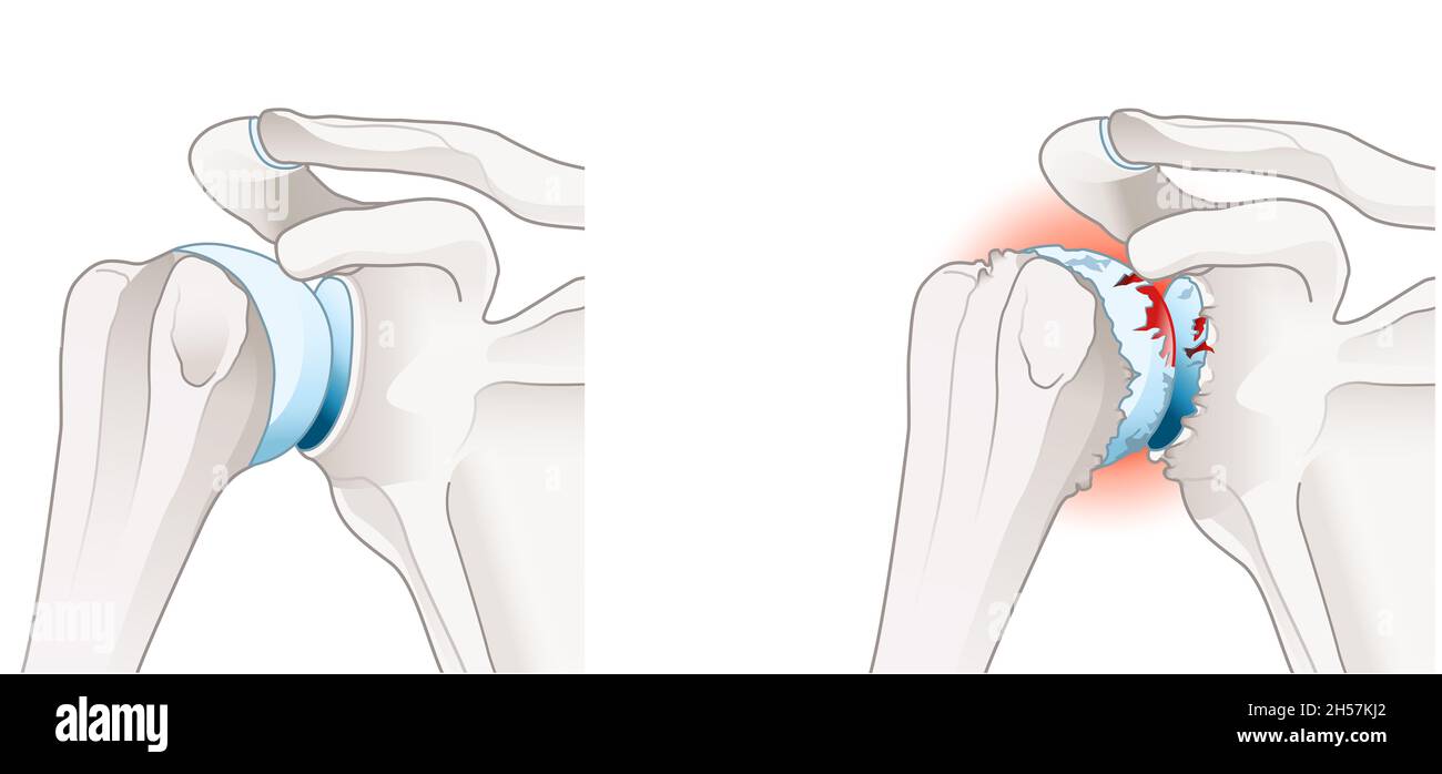 Illustration showing healthy shoulder joint and osteoarthritis of the shoulder joint Stock Photo
