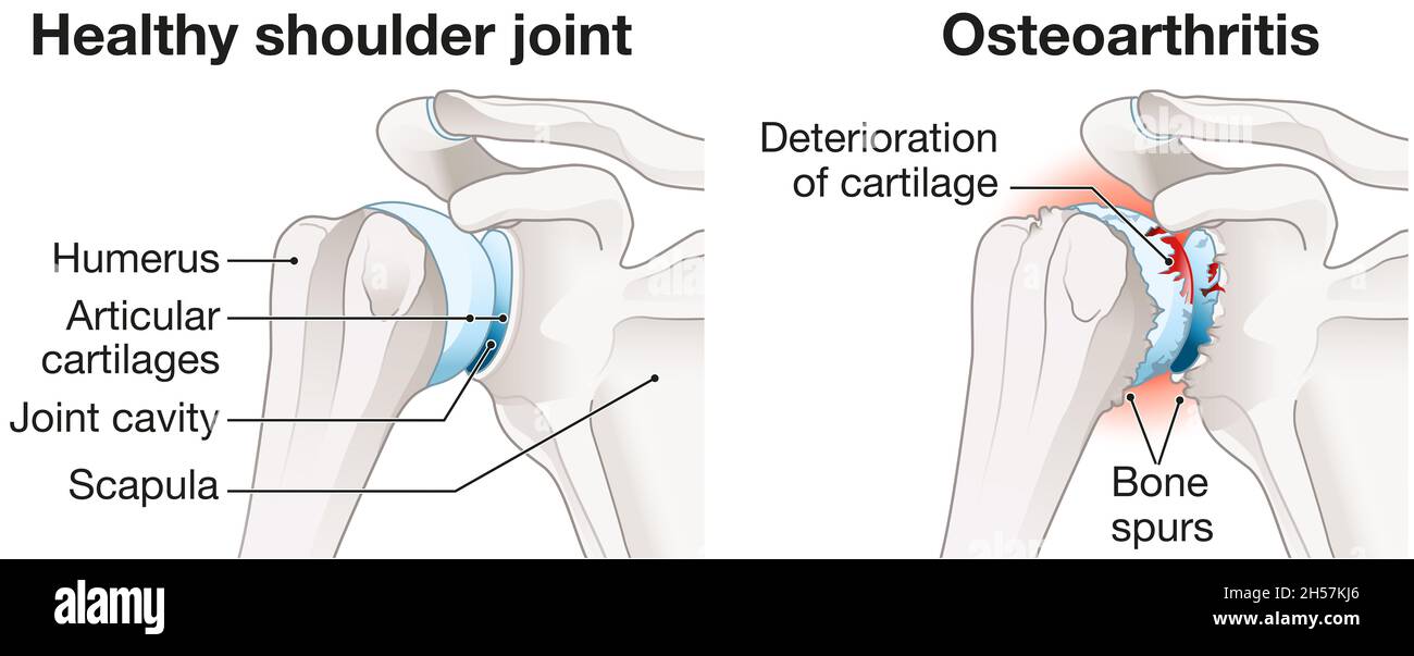 Illustration showing healthy shoulder joint and osteoarthritis of the shoulder joint Stock Photo