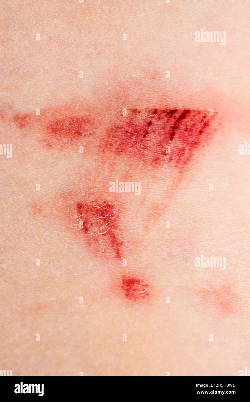 A wound on the human body. Very close up of painful wound. Stock Photo