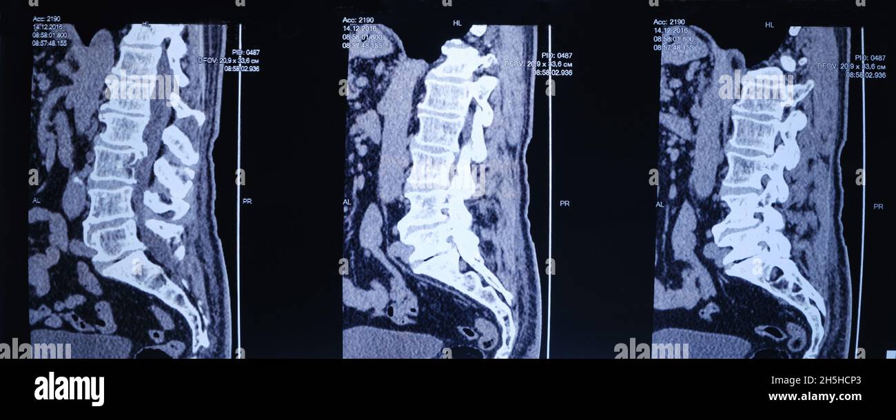 CT image of the spine of a patient with scoliosis and protrusion of the intervertebral disc. Stock Photo