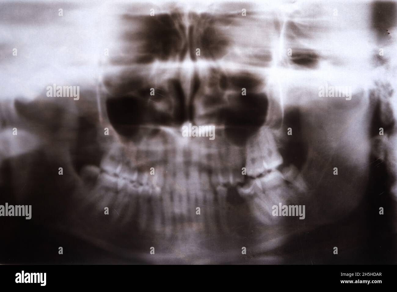 X-ray of a patient with a fracture of the upper jaw Stock Photo
