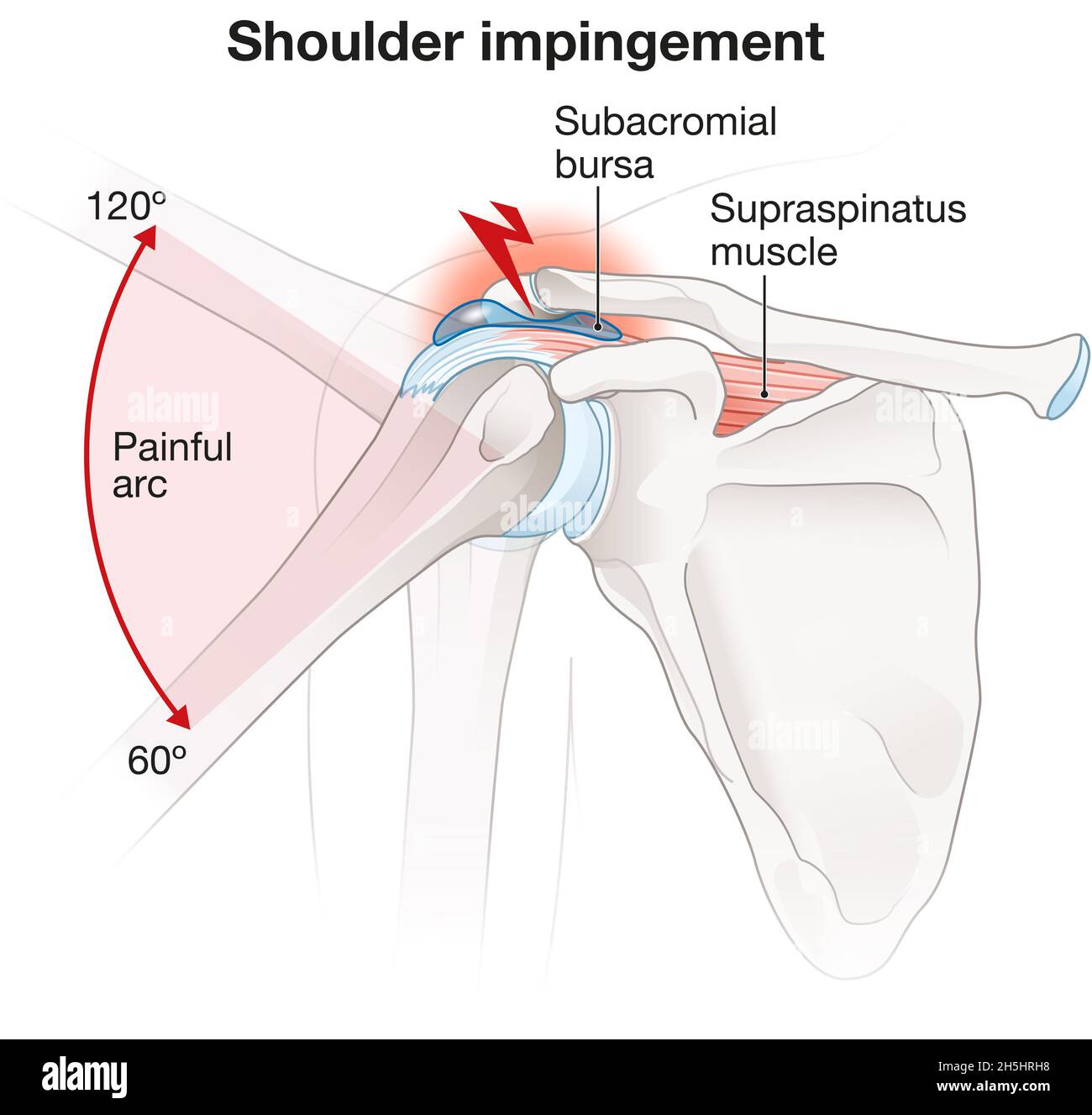 Illustration showing shoulder impingement Stock Photo