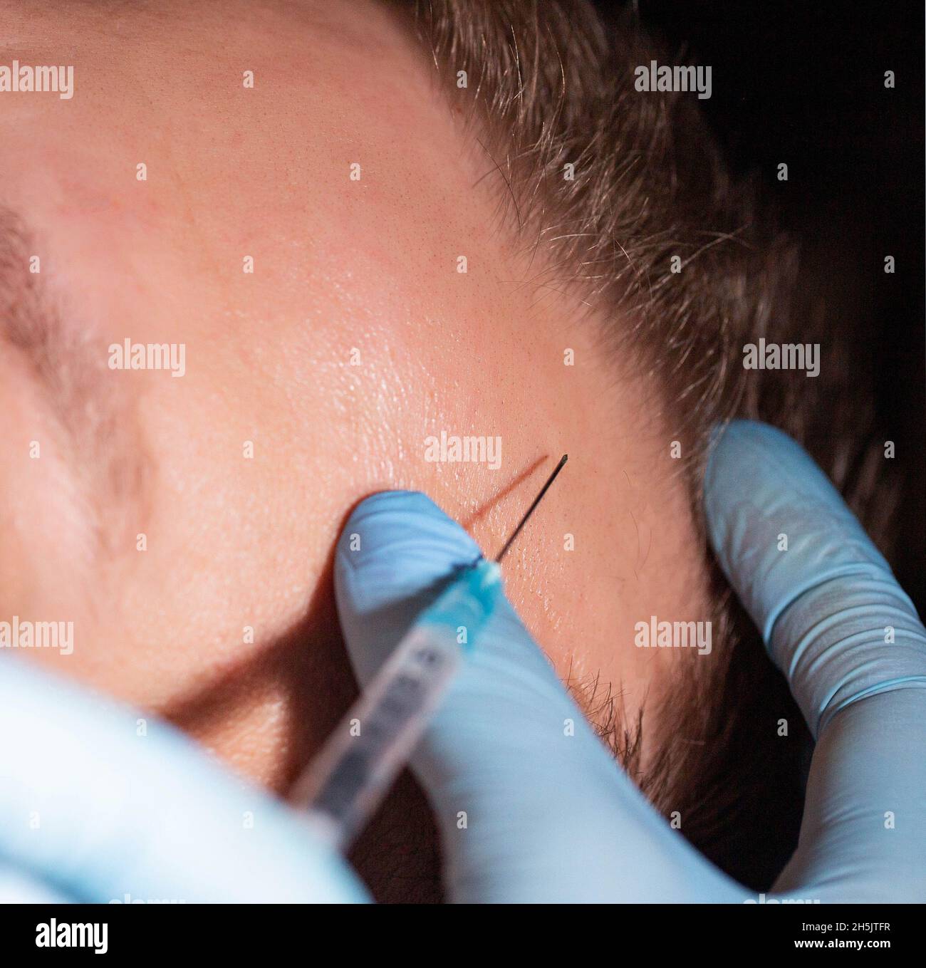 Human Skin Showing Hair Follicles High Resolution Stock Photography and ...