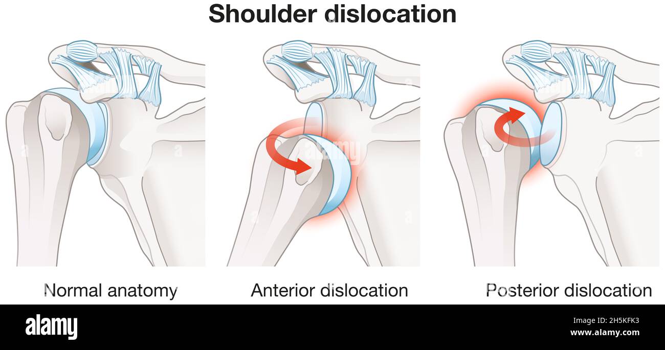 Illustration showing painful shoulder dislocation. Labeled Stock Photo