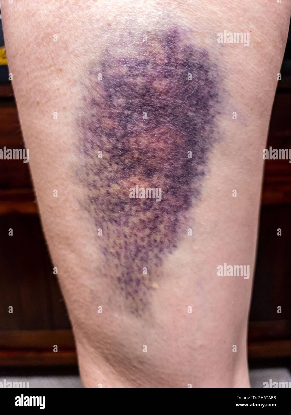 Hematoma sport hi-res stock photography and images - Alamy