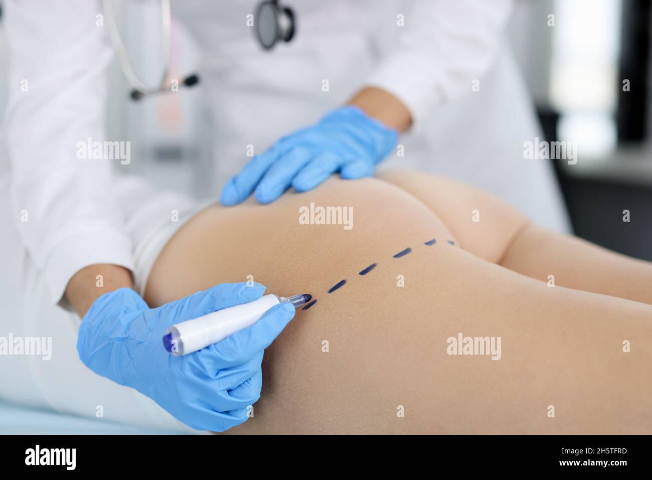Doctor draws marks on the patient's buttocks with marker for body shaping Stock Photo