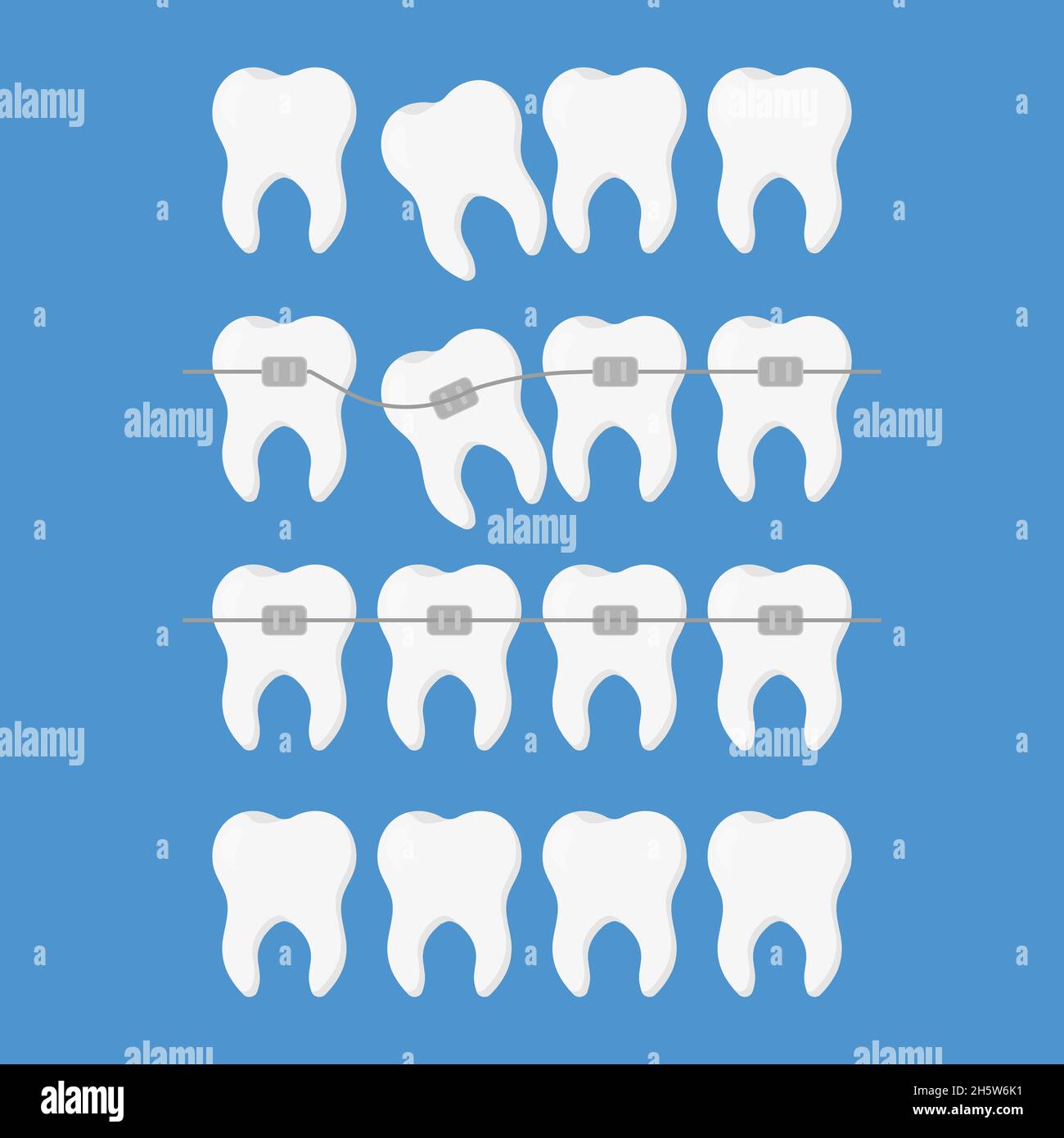 dentistry set illustration align teeth braces flat style Stock Vector