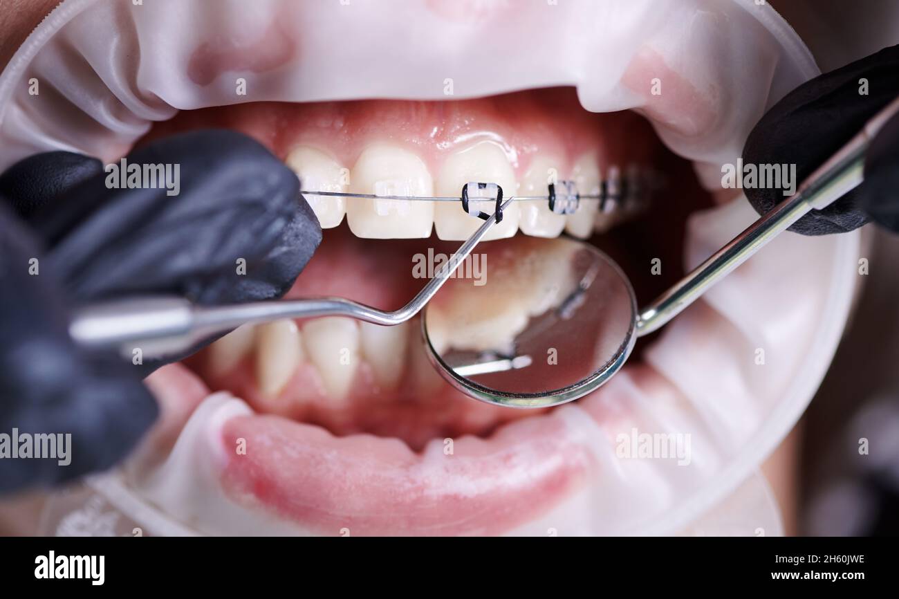 Close up view on dentist in black gloves taking off black rubber bands from  ceramic braces with a help of dental hook to replace rusty wire which  connects the braces. Concept of