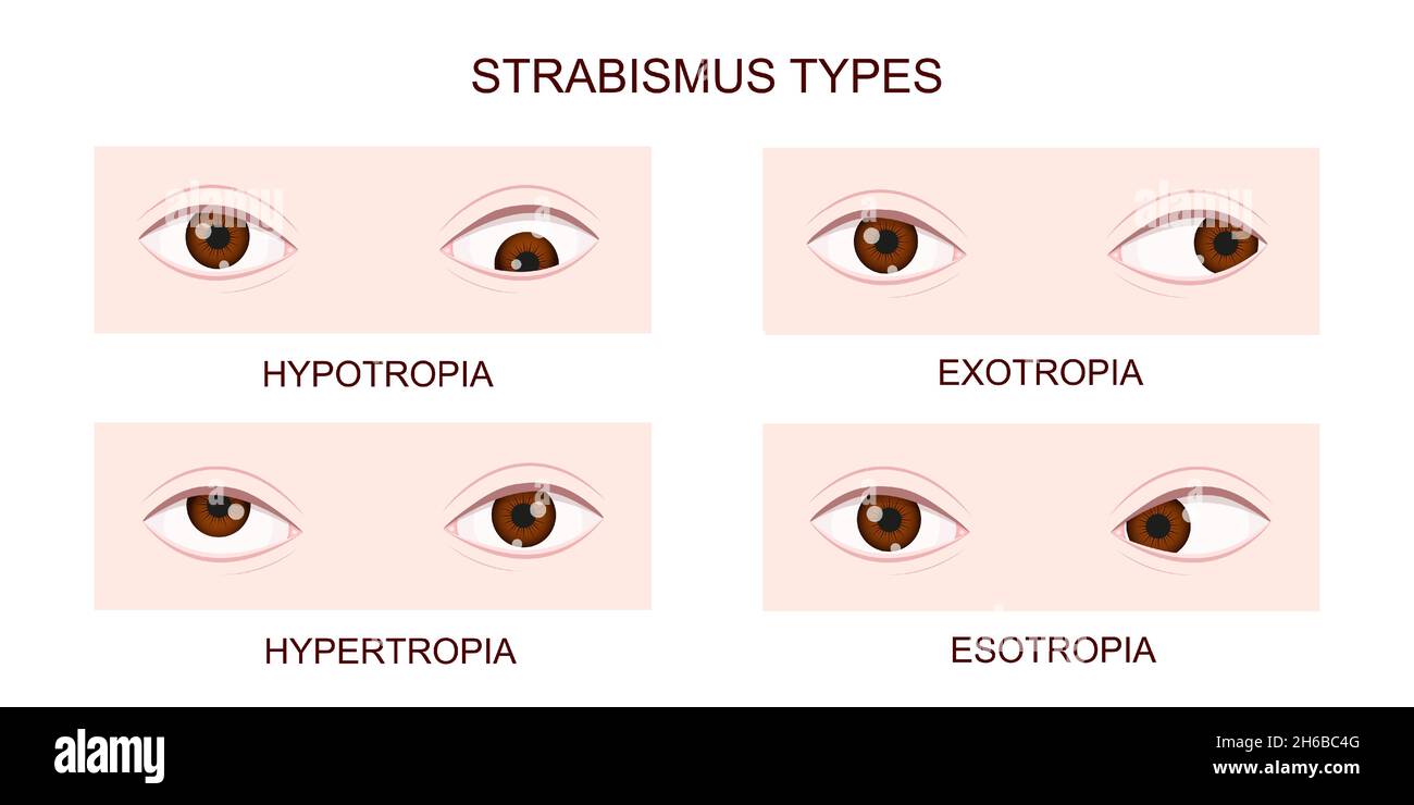 Strabismus types. Hypotropia, hypertropia, exotropia, esotropia. Human eyes with different squint disorders. Crossed eyes condition. Vector realistic illustration. Stock Vector