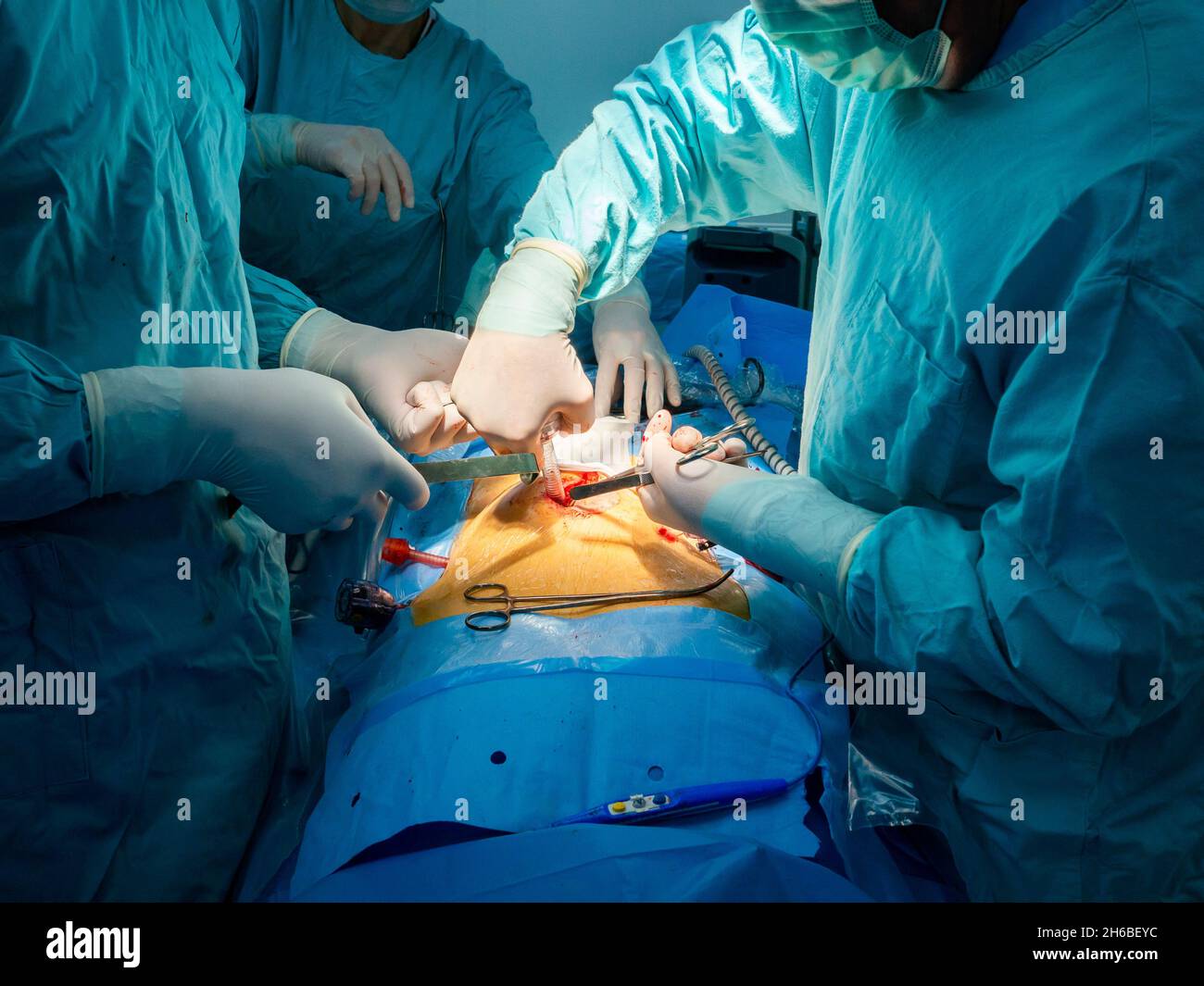 The surgeon inserts a laparoscopic surgical instrument into the patient
