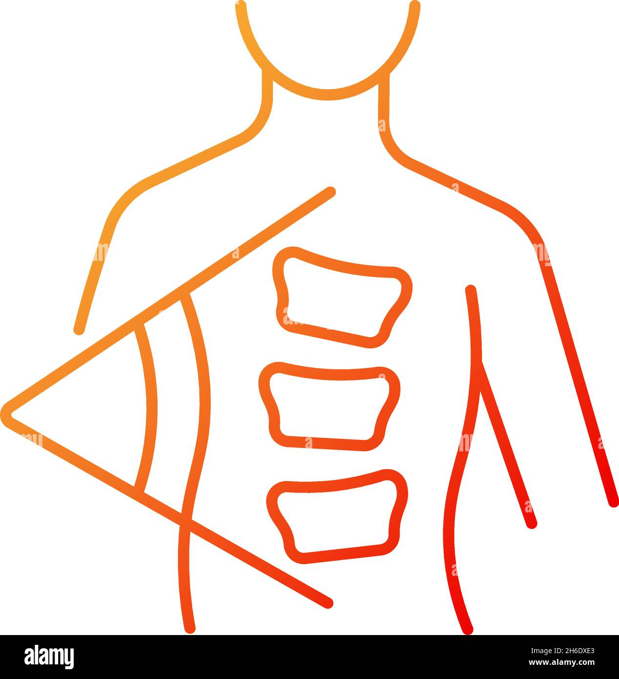 Scoliosis gradient linear vector icon. Sideways curve. Uneven hips and  shoulders. Pinched nerves. Back pain, stiffness. Thin line color symbols.  Moder Stock Vector Image & Art - Alamy