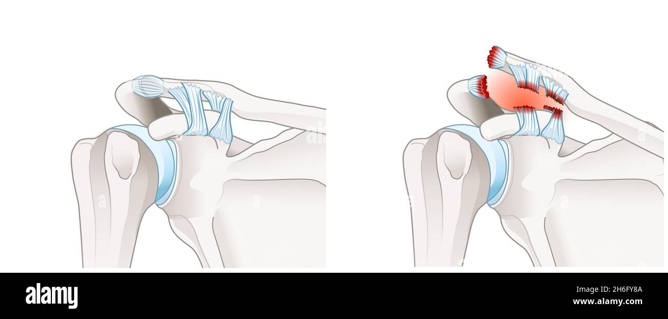 Illustration showing acromioclavicular joint separation or AC joint separation or shoulder separation. Illustration Stock Photo