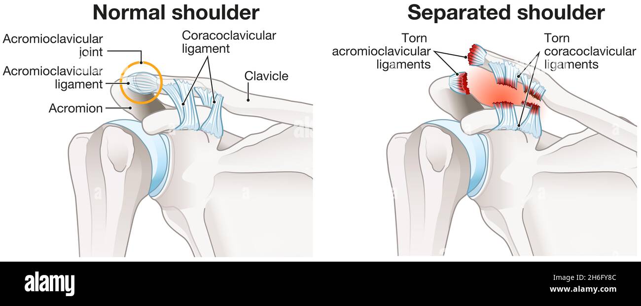 Illustration showing acromioclavicular joint separation or AC joint separation or shoulder separation. Illustration Stock Photo
