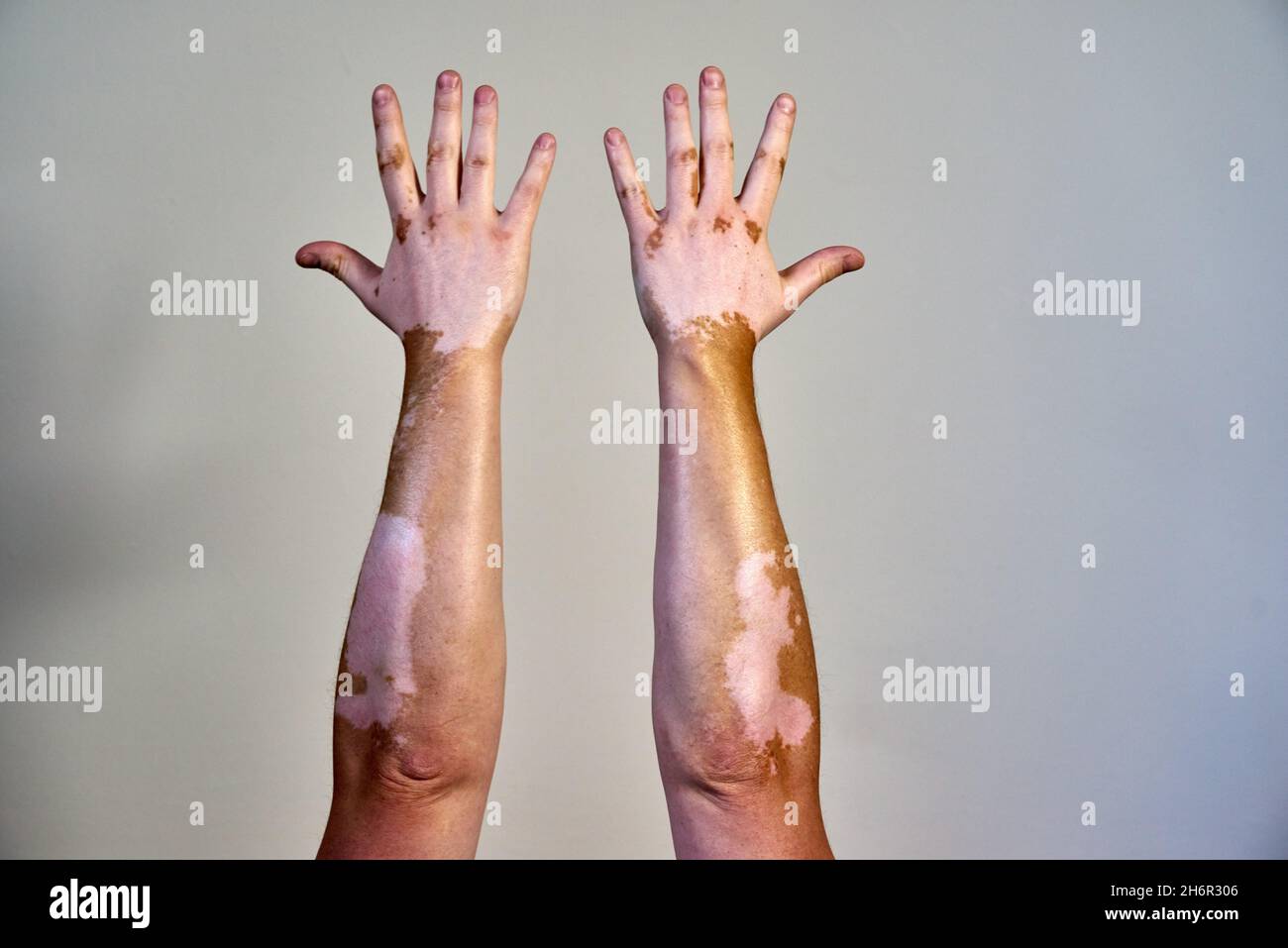 Vitiligo skin disease on male hands Stock Photo